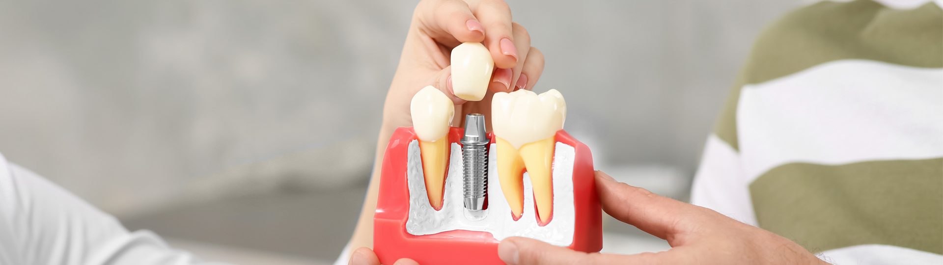 What Affects the Longevity of Dental Implants?