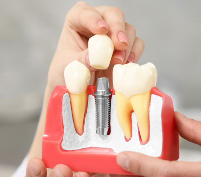 What Affects the Longevity of Dental Implants?