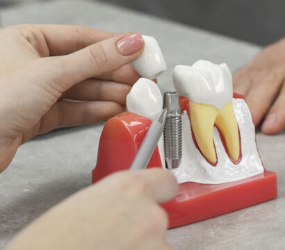 The Effects of Soda on Dental Implants: A Detailed Analysis