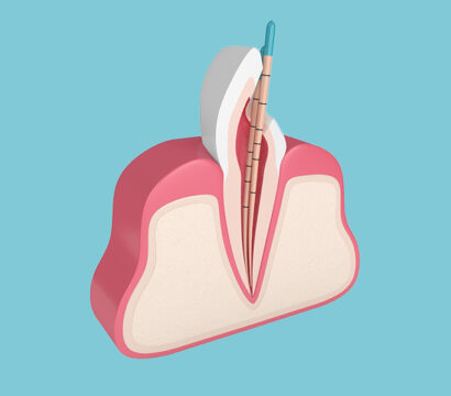 Why Do Root Canals Sometimes Need Retreatment? Causes and Solutions