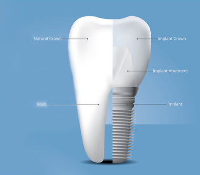 How Dental Implants Help to Restore Your Smile