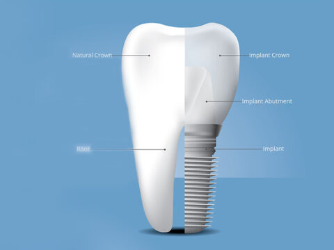 How Dental Implants Help to Restore Your Smile