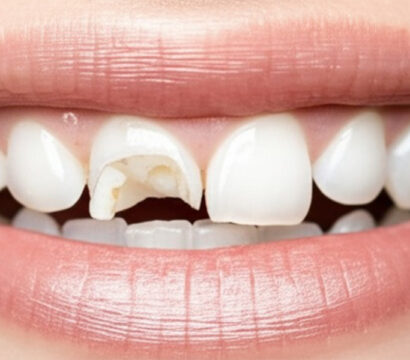 A Tooth Broke Suddenly? Here’s What Queen Creek Patients Should Know