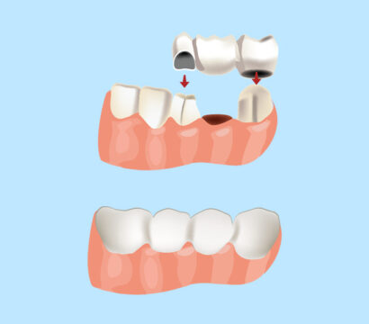 Affordable and Durable: Dental Bridge Options for Queen Creek Residents