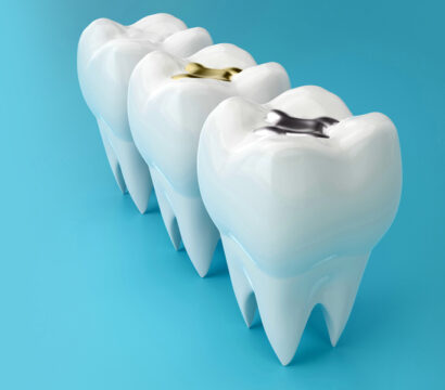 What to Anticipate During a Dental Filling Appointment in Queen Creek?