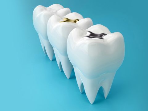 What to Anticipate During a Dental Filling Appointment in Queen Creek?