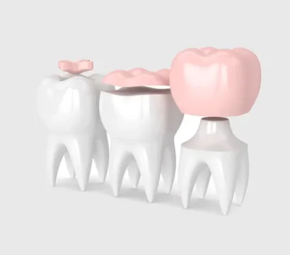 Boost Your Dental Health with Inlays and Onlays in Queen Creek