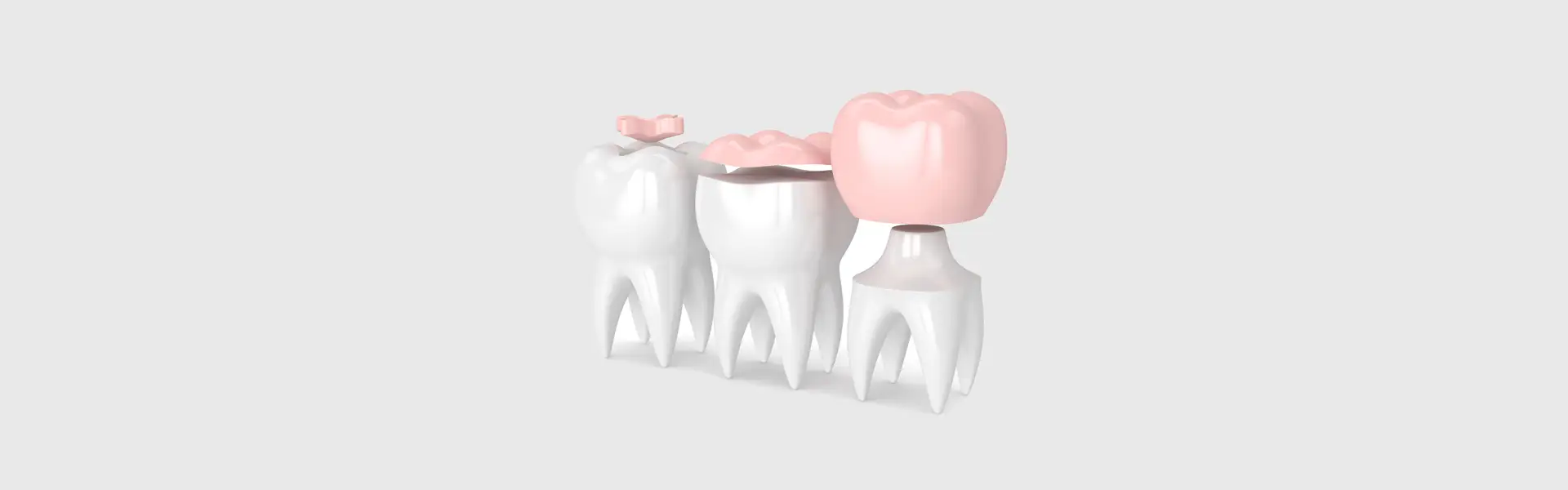 Boost Your Dental Health with Inlays and Onlays in Queen Creek
