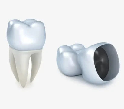 Cracked Tooth? Walk In & Walk Out Smiling with Same-Day Crowns