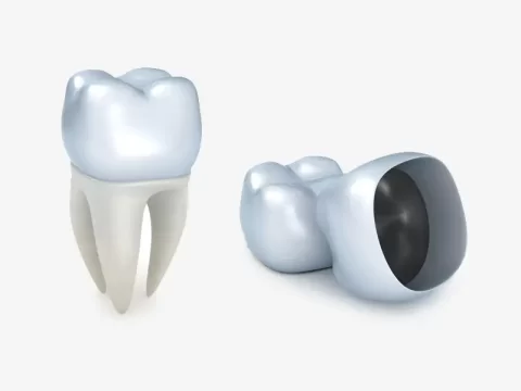 Cracked Tooth? Walk In & Walk Out Smiling with Same-Day Crowns